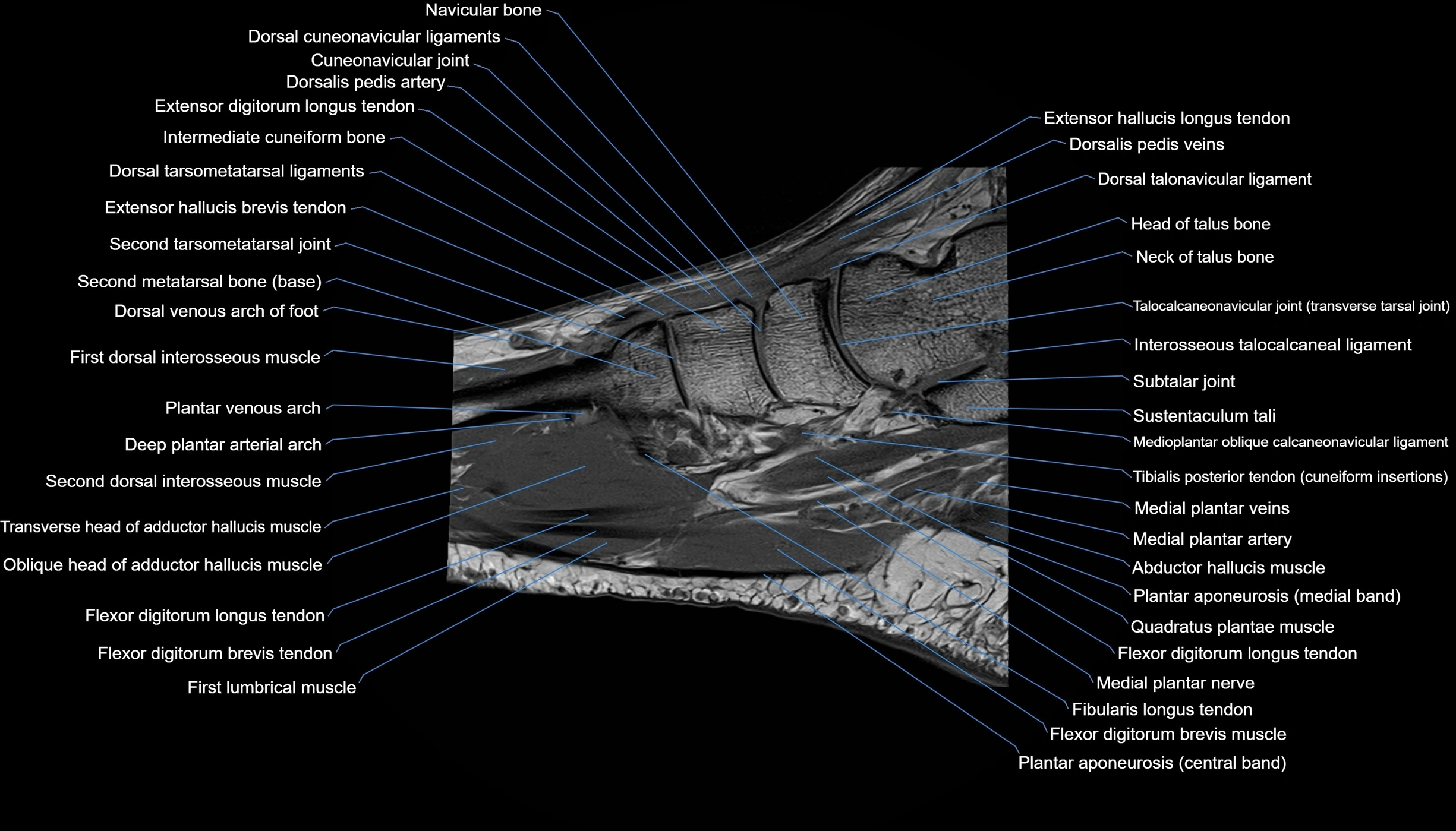 MRI mid foot sagittal cross sectional anatomy 3T  radiology  image-img-00001-00026.webp